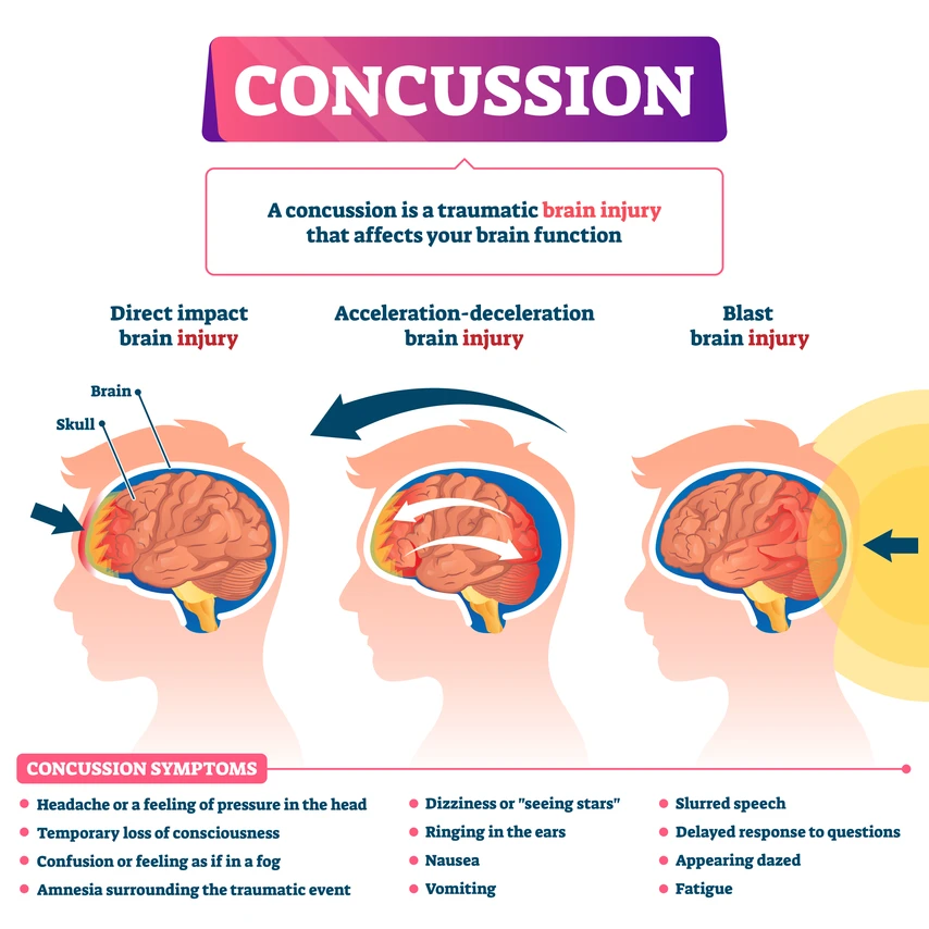 Concussion graphic 2